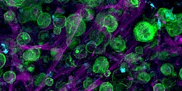 科學家團隊在實驗室中創建了一個三維 (3D) 胰腺癌腫瘤模型